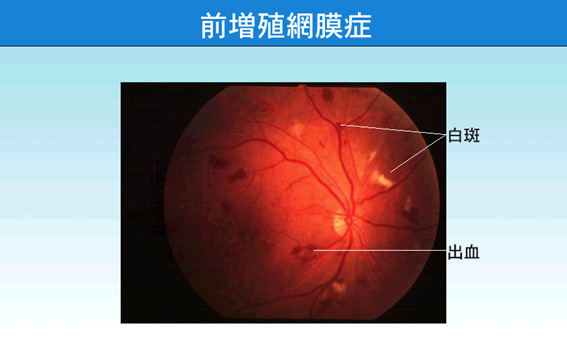 前増殖網膜症