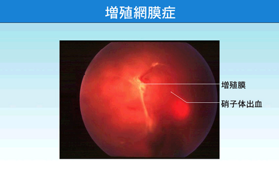 増殖網膜症